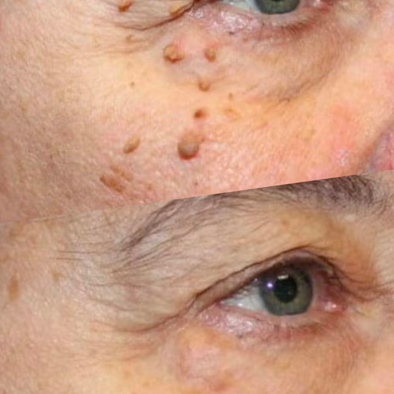 45-Minutes Skin-Tag Removal Session 45-Minutes Skin-Tag Removal Session
